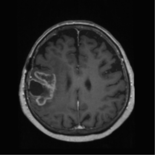 File:Anaplastic astrocytoma IDH wild-type (pseudoprogression) (Radiopaedia 42209-45278 Axial T1 C+ 104).png
