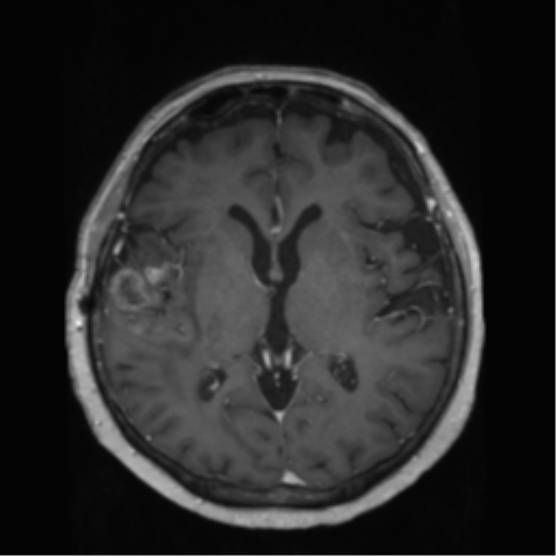 File:Anaplastic astrocytoma IDH wild-type (pseudoprogression) (Radiopaedia 42209-45278 Axial T1 C+ 84).png