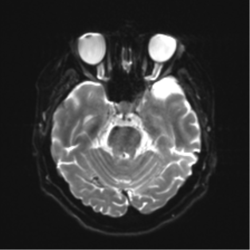 Anaplastic astrocytoma IDH wild-type (pseudoprogression) (Radiopaedia 42209-45279 Axial DWI 9).png