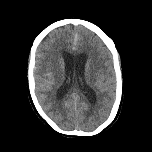 File:Aneursym related subarachnoid hemorrhage with hydrocephalus (Radiopaedia 45105-49083 Axial non-contrast 28).jpg