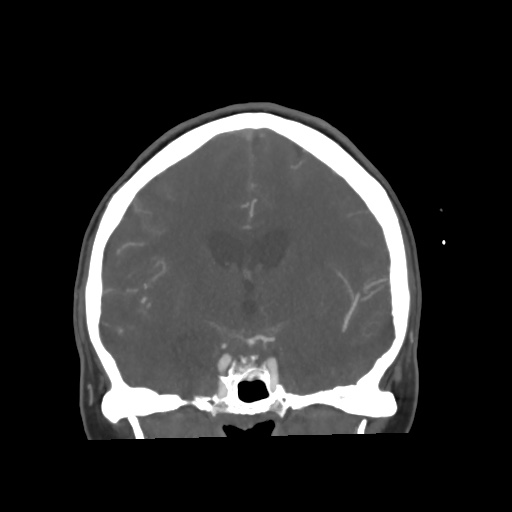 Aneursym related subarachnoid hemorrhage with hydrocephalus (Radiopaedia 45105-49084 B 39).jpg