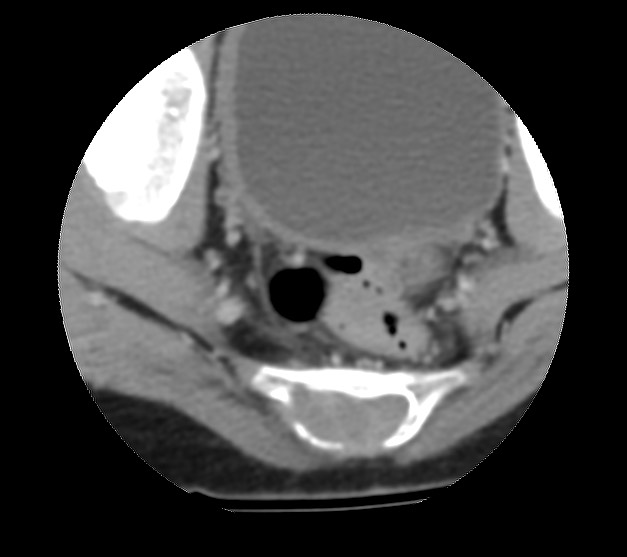 Aneurysmal bone cyst - sacrum (Radiopaedia 65190-74195 Axial non-contrast 38).jpg
