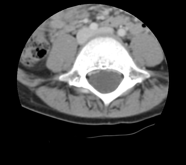 Aneurysmal bone cyst - sacrum (Radiopaedia 65190-74195 Axial non-contrast 8).jpg