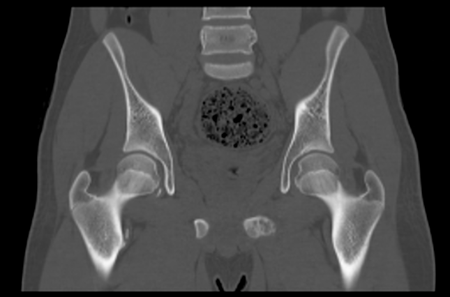 File:Aneurysmal bone cyst of ischium (Radiopaedia 25957-26094 Coronal bone window 22).png