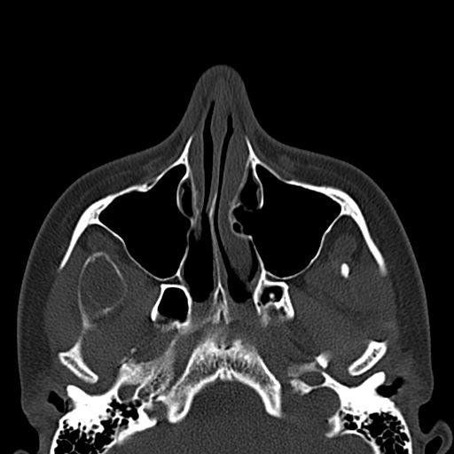 Aneurysmal bone cyst of the mandible (Radiopaedia 43280-46601 Axial bone window 72).jpg
