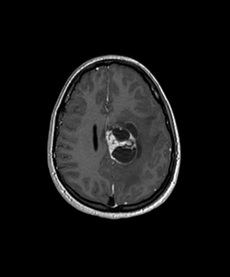 Angiomatous meningioma (Radiopaedia 79459-92577 Axial T1 C+ 3D ISO 29).jpg