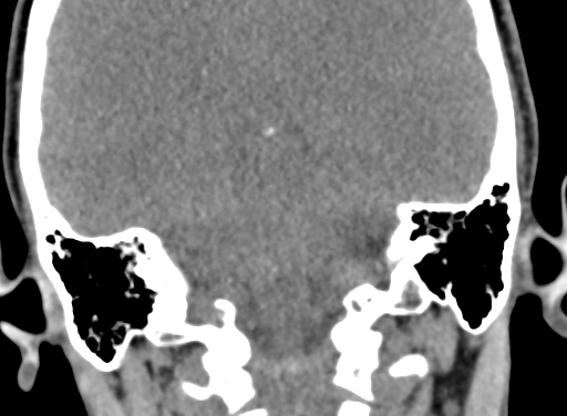 Angular dermoid cyst (Radiopaedia 88967-105790 Coronal non-contrast 85).jpg