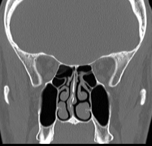 Angular epidermoid cyst (Radiopaedia 46908-51439 Coronal bone window 35).png