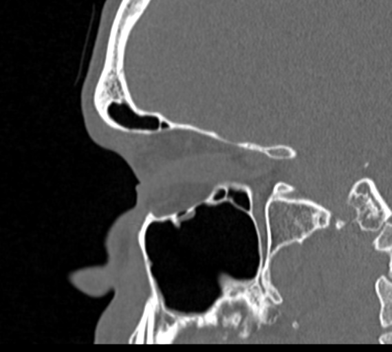 Angular epidermoid cyst (Radiopaedia 46908-51439 Sagittal bone window 61).png