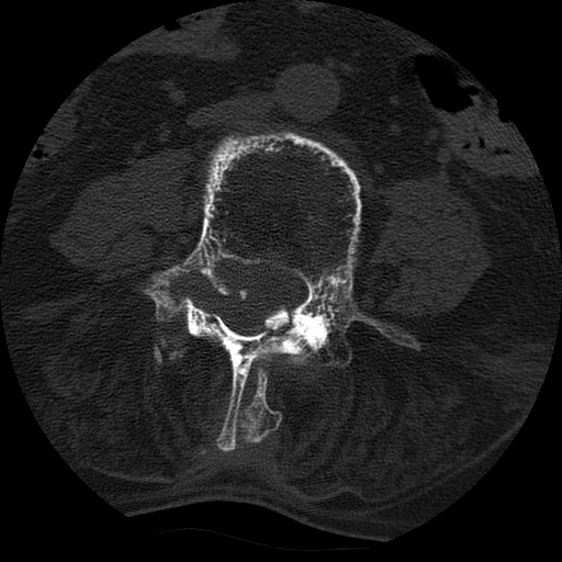 Ankylosing spondylitis complicated by fracture-dislocation (Radiopaedia 33583-34674 Axial non-contrast 98).jpg