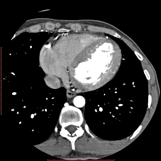 File:Anomalous left coronary artery from the pulmonary artery (ALCAPA) (Radiopaedia 70148-80181 A 270).jpg