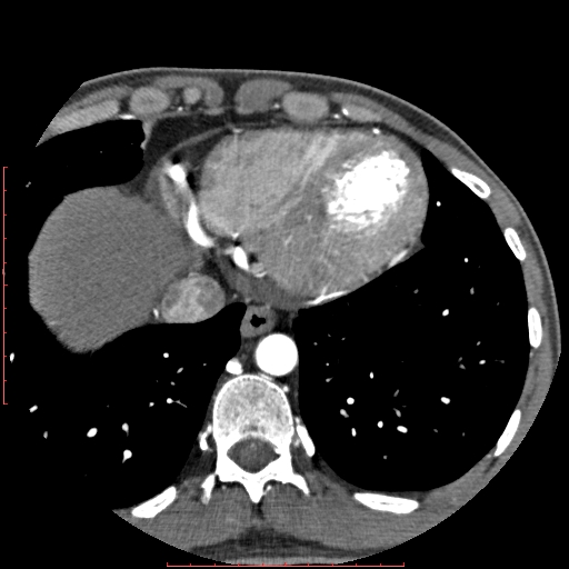 Anomalous left coronary artery from the pulmonary artery (ALCAPA) (Radiopaedia 70148-80181 A 321).jpg