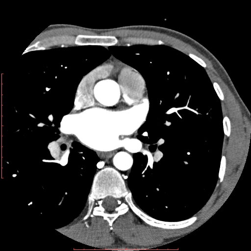 File:Anomalous left coronary artery from the pulmonary artery (ALCAPA) (Radiopaedia 70148-80181 A 81).jpg