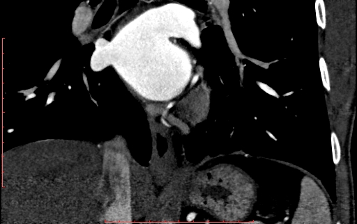 Anomalous left coronary artery from the pulmonary artery (ALCAPA) (Radiopaedia 70148-80181 B 219).jpg