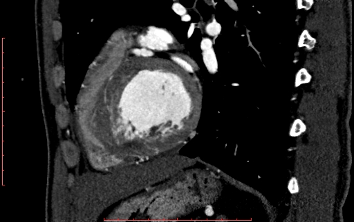 File:Anomalous left coronary artery from the pulmonary artery (ALCAPA) (Radiopaedia 70148-80181 C 173).jpg