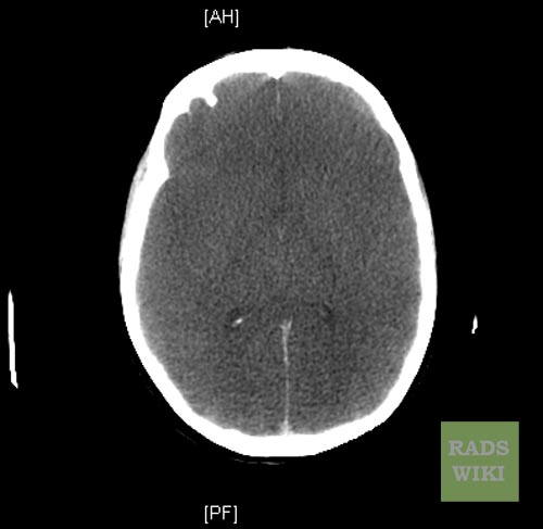 File:Anoxic brain injury (Radiopaedia 11191-11556 C 1).jpg