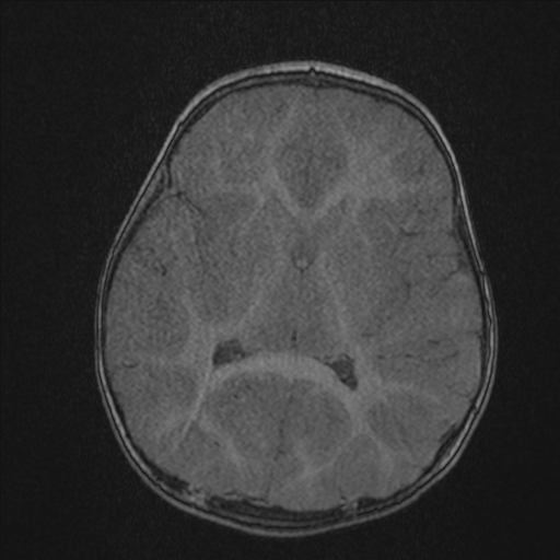 Anoxic brain injury (Radiopaedia 79165-92139 Axial MRA 133).jpg