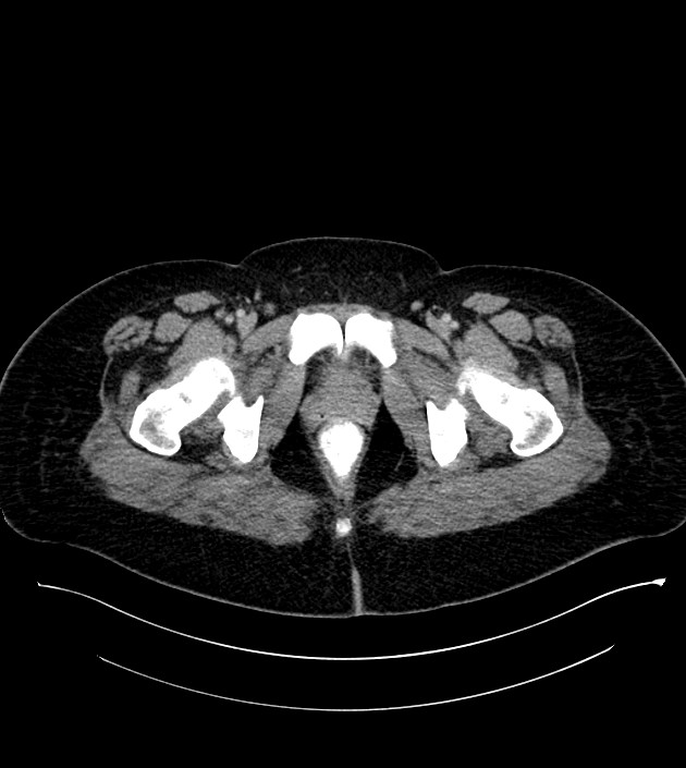 Anterior abdominal wall CSF pseudocyst (CSFoma) (Radiopaedia 79453-92571 A 92).jpg