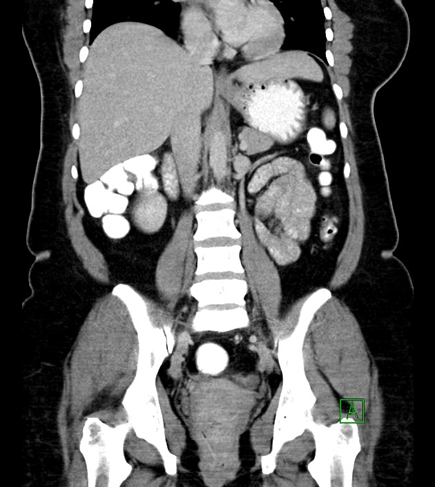 Anterior abdominal wall CSF pseudocyst (CSFoma) (Radiopaedia 79453-92571 B 33).jpg