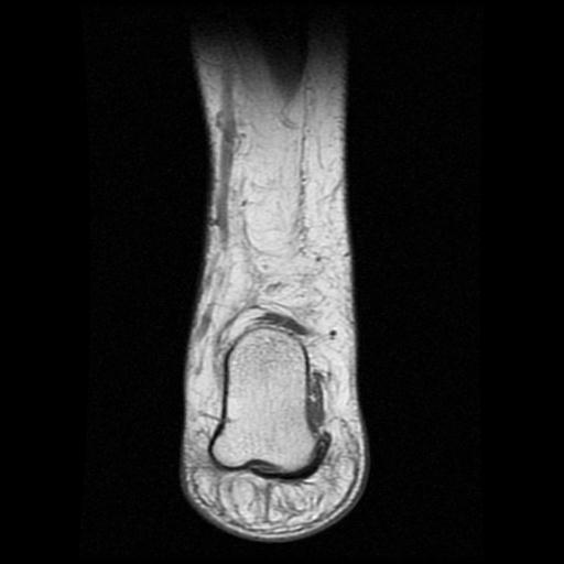 File:Anterior calcaneal process fracture (Radiopaedia 71377-81705 Coronal T1 15).jpg