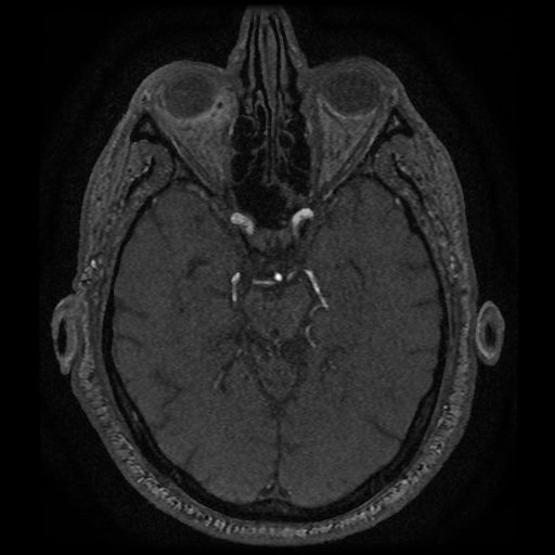 Anterior cerebral artery infarction (Radiopaedia 46794-51323 Axial MRA 69).jpg