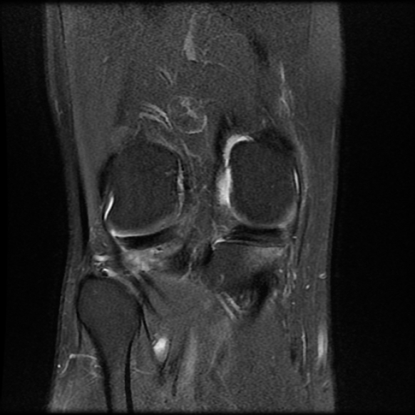File:Anterior cruciate ligament graft tear and bucket-handle tear of medial meniscus (Radiopaedia 75867-87254 Coronal PD fat sat 18).jpg