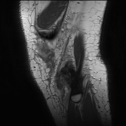 Anterior cruciate ligament rupture with Segond fracture (Radiopaedia 69043-78806 Sagittal PD 174).jpg