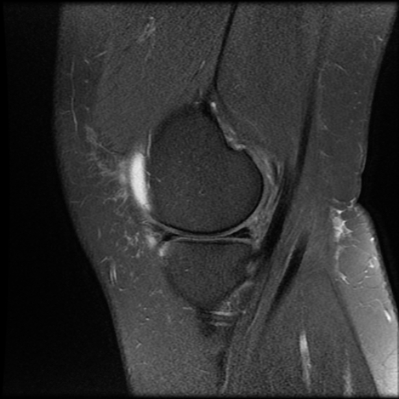 File:Anterior cruciate ligament tear, Wrisberg rip and bucket-handle tear of medial meniscus (Radiopaedia 75872-87266 Sagittal PD fat sat 21).jpg