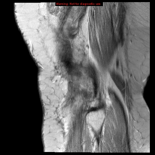 File:Anterior cruciate ligament tear (Radiopaedia 12329-12612 Sagittal T2 fat sat 1).jpg