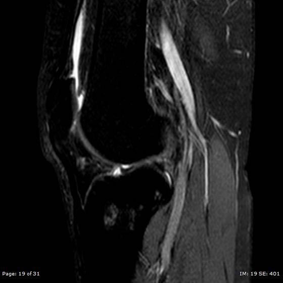 File:Anterior cruciate ligament tear (Radiopaedia 70783-80964 Sagittal STIR 19).jpg
