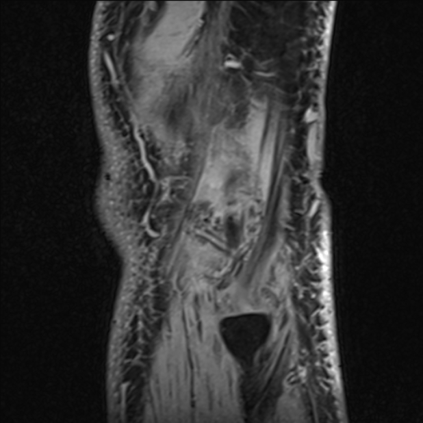 Anterior cruciate ligament tear - ramp lesion (Radiopaedia 71883-82322 Sagittal T1 vibe 15).jpg