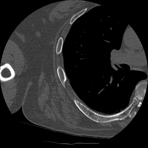 Anterior glenohumeral dislocation with Hill-Sachs lesion (Radiopaedia 62877-71249 Axial bone window 93).jpg