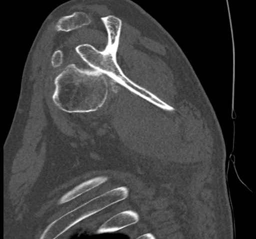 Anterior glenohumeral dislocation with Hill-Sachs lesion (Radiopaedia 62877-71249 Sagittal bone window 34).jpg