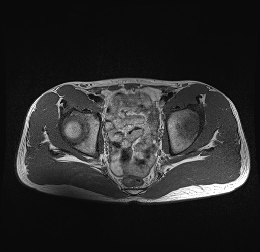 File:Anterior inferior iliac spine avulsion fracture (Radiopaedia 81312-95000 Axial T1 20).jpg