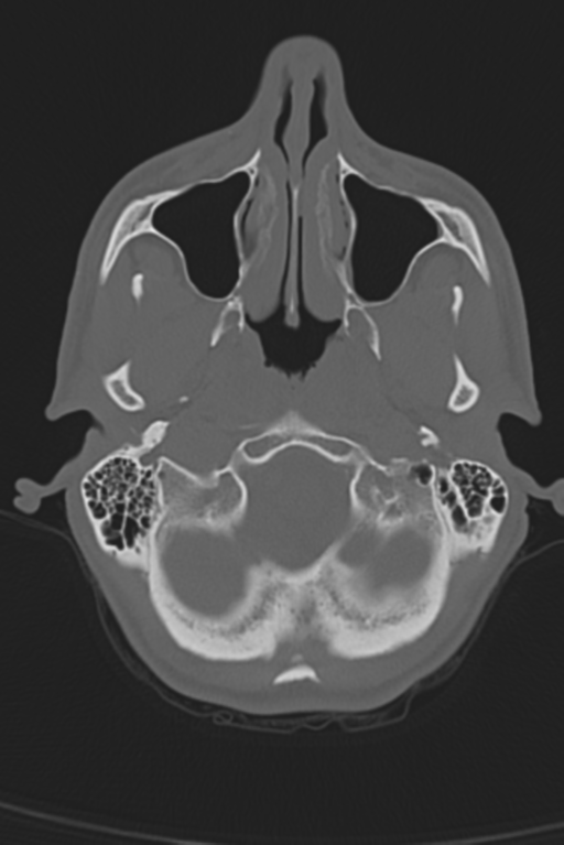 Anterior nasal spine fracture (Radiopaedia 46138-50494 Axial bone window 50).png