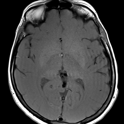 File:Anterior temporal encephalocele (Radiopaedia 82624-96808 Axial T1 19).jpg