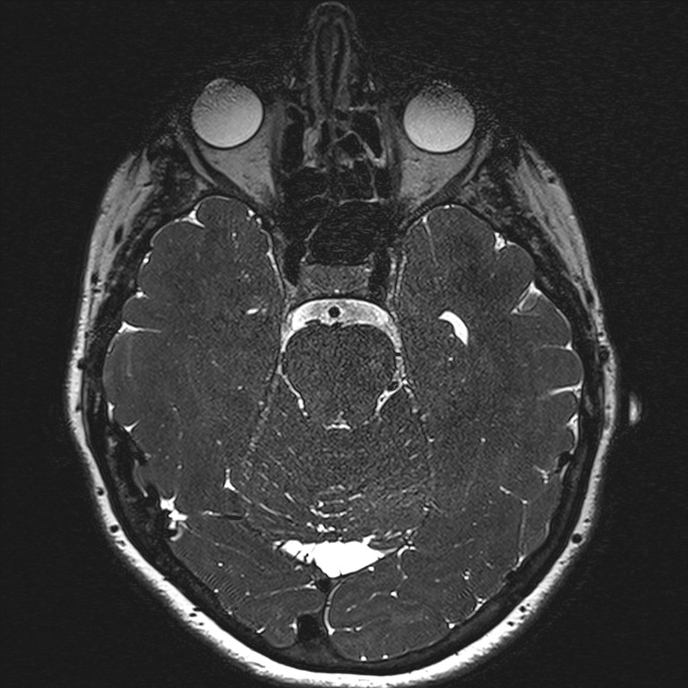 Anterior temporal encephalocele (Radiopaedia 82624-96808 Axial T2 high res 66).jpg