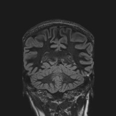 Anterior temporal encephalocele (Radiopaedia 82624-96808 Coronal FLAIR 36).jpg