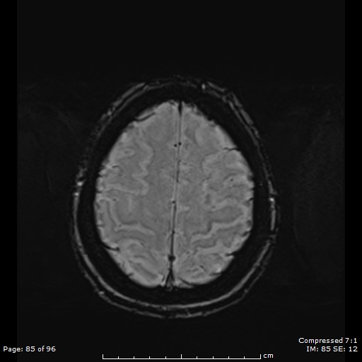 Anterior temporal lobe perivascular space (Radiopaedia 88283-104914 Axial SWI 54).jpg
