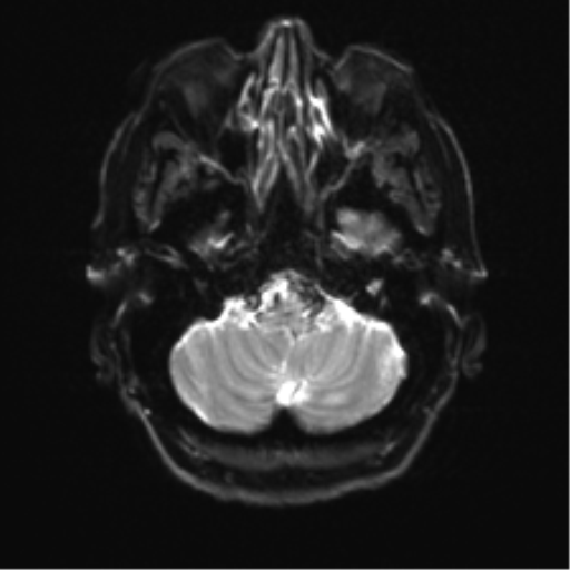 Anterior temporal pole cysts (Radiopaedia 46629-51102 Axial DWI 5).png