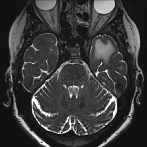 Anterior temporal pole cysts (Radiopaedia 46629-51102 Axial T2 52).png