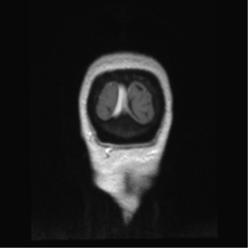 Anterior temporal pole cysts (Radiopaedia 46629-51102 Coronal T1 C+ 5).png