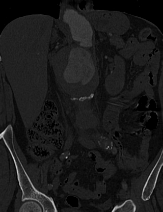 Anterior vertebral scalloping (abdominal aortic aneurysm) (Radiopaedia 66744-76067 Coronal bone window 20).jpg