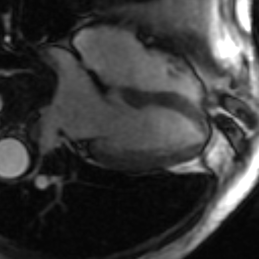 File:Anteroseptal hypokinesia after myocardial infarction (Radiopaedia 15978-15633 4 chamber view SSFE 11).jpg