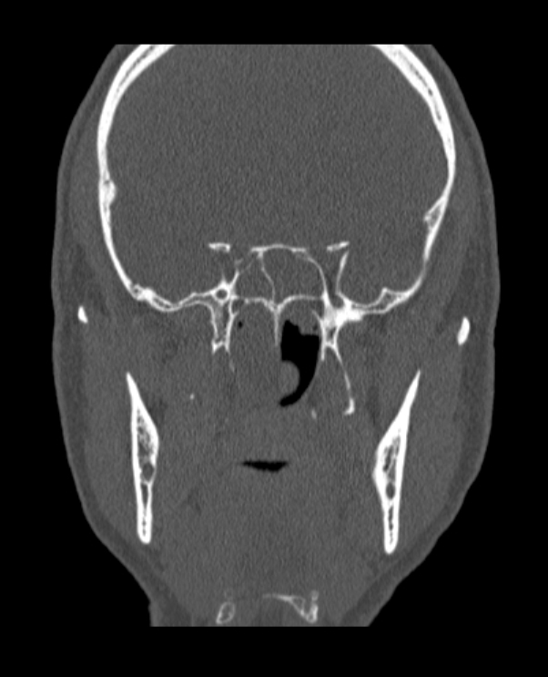 Antrochoanal polyp (Radiopaedia 79011-92169 Coronal bone window 25).jpg