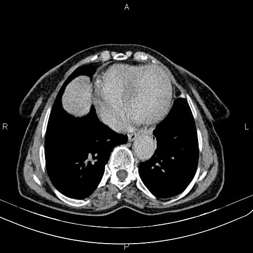 Aortic aneurysm and Lemmel syndrome (Radiopaedia 86499-102554 Axial C+ delayed 4).jpg