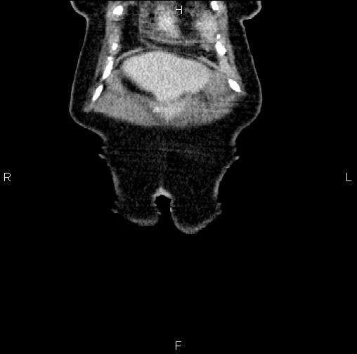 File:Aortic aneurysm and Lemmel syndrome (Radiopaedia 86499-102554 C 1).jpg