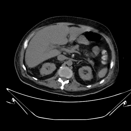 Aortic arch aneurysm (Radiopaedia 84109-99365 Axial non-contrast 300).jpg