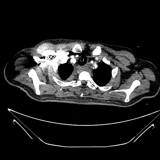 Aortic arch aneurysm (Radiopaedia 84109-99365 B 90).jpg