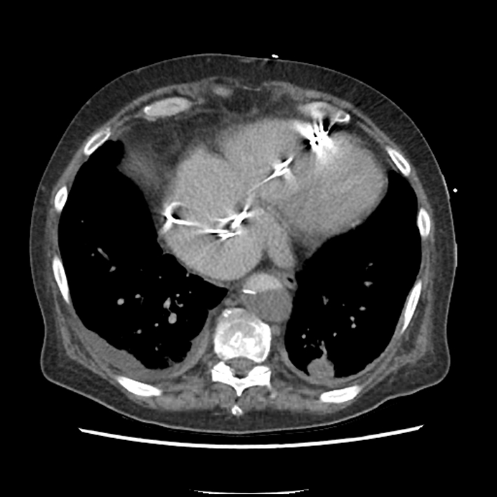 Aortic arch graft infection (FDG PET-CT) (Radiopaedia 71975-82437 A 46).jpg